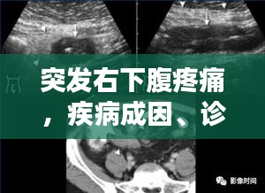 突发右下腹疼痛，疾病成因、诊断方法与治疗方案探讨