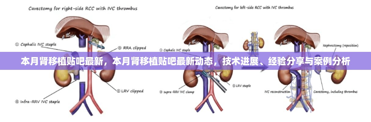本月肾移植贴吧最新动态，技术进展、经验分享与案例分析全解析