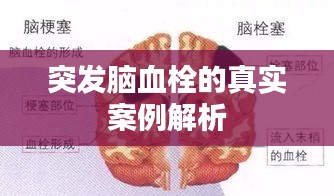 突发脑血栓的真实案例解析